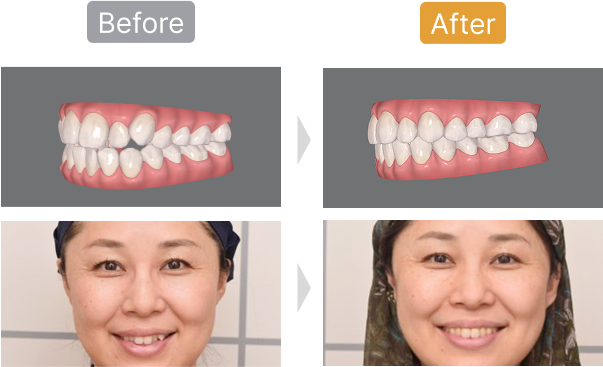 矯正のビフォーとアフターの歯並びをシミュレーションした様子