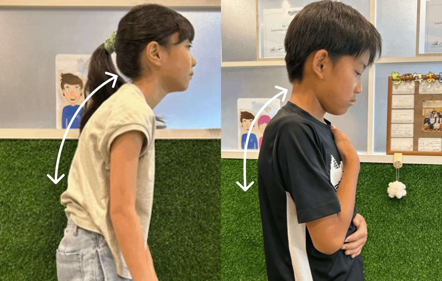 矯正のビフォーとアフターの歯並びをシミュレーションした様子